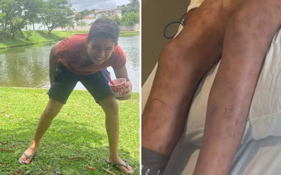 Menino atacado por enxame de abelhas fica irreconhecível e segue internado na UTI