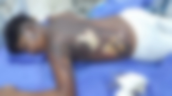 Adolescente de 13 anos sofre queimaduras graves pelo corpo e é levado ao hospital em MT