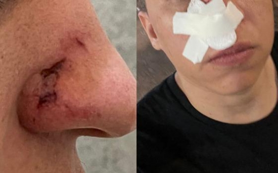 Advogado fica ferido ao ser atingido por ‘pedrada’ no rosto durante Expoleste, em Barra do Garças
