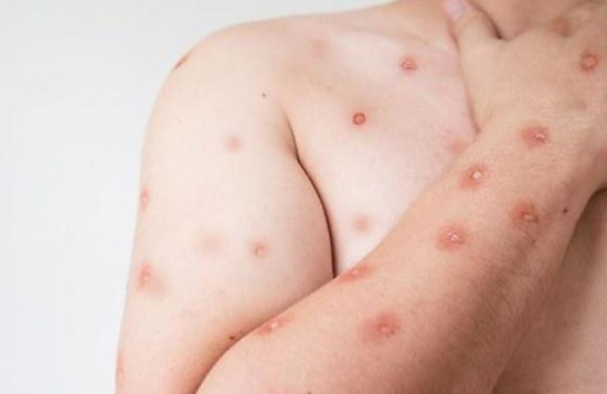 SES alerta para monitoramento de casos de Mpox em MT após avanço de variante em Rondônia