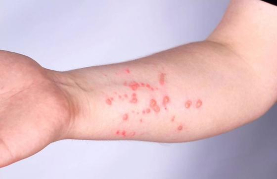 Brasil registra 140 casos de mpox em 2026 e investiga mais de 500 suspeitas