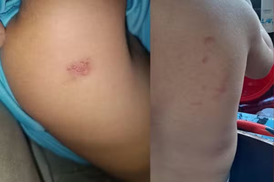 Mãe denuncia professora após criança de 2 anos apresentar hematomas