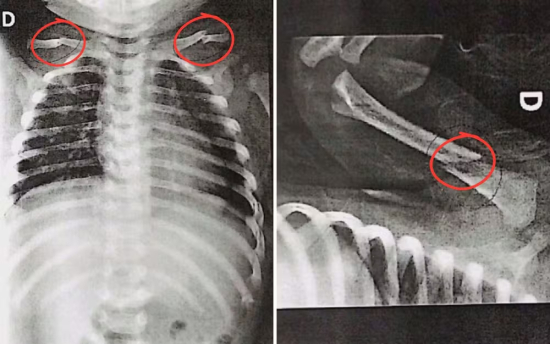 Bebê de 50 dias é internada com várias fraturas pelo corpo e casal é preso por suspeita de maus-tratos