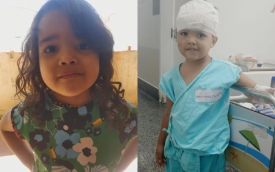 Menina de 4 anos é atacada por pit bull e fica ferida na cabeça