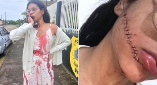 Enquanto dormia durante viagem, estudante sofre ataque e tem rosto rasgado com faca