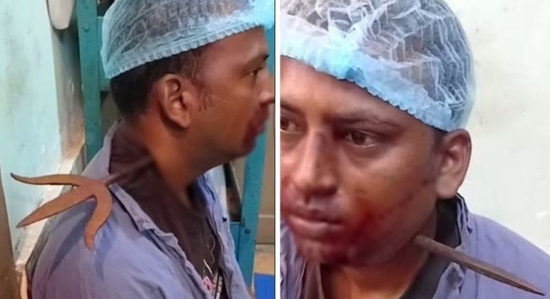 Homem briga com colegas e acaba com tridente de 150 anos atravessado no pescoço: 'Não doeu'