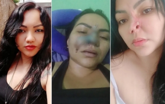 Alectomia: entenda riscos de procedimento feito por mulher que perdeu parte do nariz após cirurgia com dentista