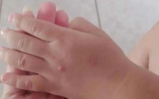 Síndrome mão-pé-boca: Goiás registra surtos em 14 cidades; veja prevenção e tratamento