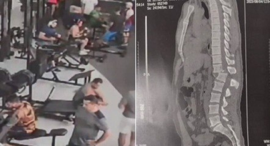 Veja dicas para evitar acidentes na academia como o que fraturou coluna de homem no Ceará