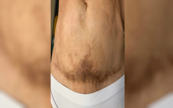 Mulher denuncia que teve sequelas após cirurgias plásticas e processa médico: 'Meu corpo está deformado'