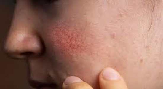 MT deve registrar 2,3 mil novos casos de câncer de pele até 2025, diz pesquisa