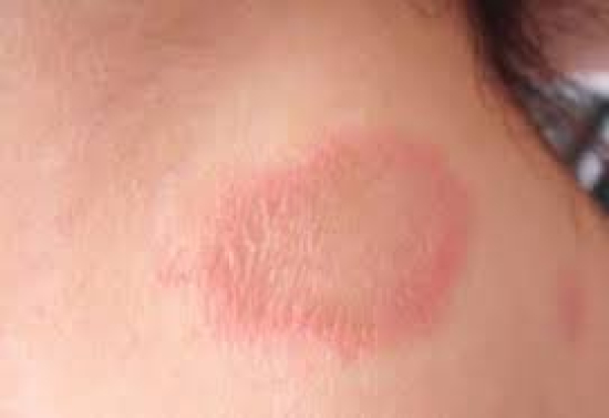 MT é o estado com maior taxa de detecção de hanseníase no país, diz Ministério da Saúde