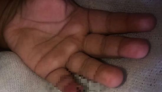 Mulher denuncia que filho perdeu pedaço do dedo em CMEI 