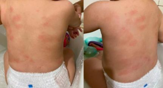 Mãe denuncia maus-tratos em creche municipal ao buscar filha com hematomas