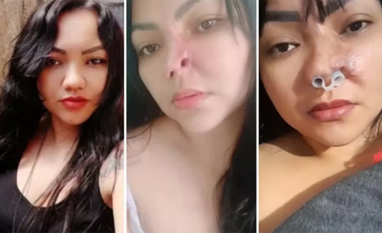 Paciente que perdeu parte do nariz após cirurgia com dentista já fez 20 procedimentos reconstrutores: 'Só quero retomar minha vida'