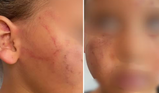 Mãe é presa suspeita de morder e espancar filha de 4 anos após criança fazer xixi na roupa