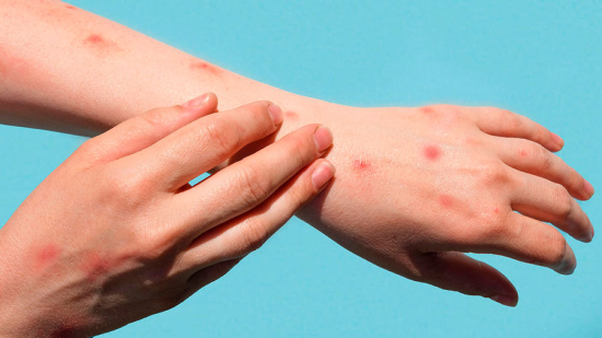 OMS declara mpox como emergência em saúde pública global