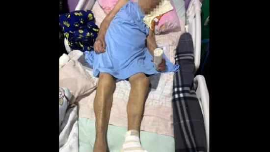 Idosa de 103 anos tem pé amputado sem anestesia e com bisturi cego no DF