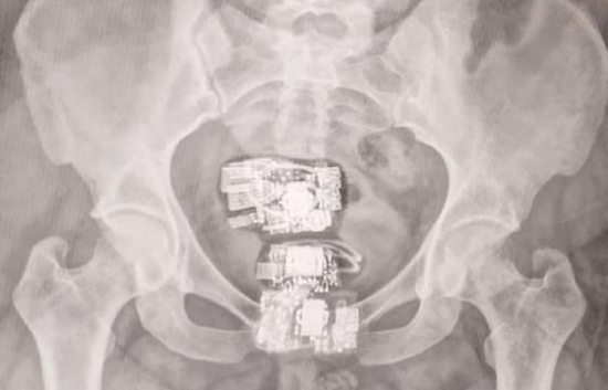 Mulher é flagrada com celulares, carregadores e medicamentos no corpo ao tentar entrar em presídio em Barra do Garças