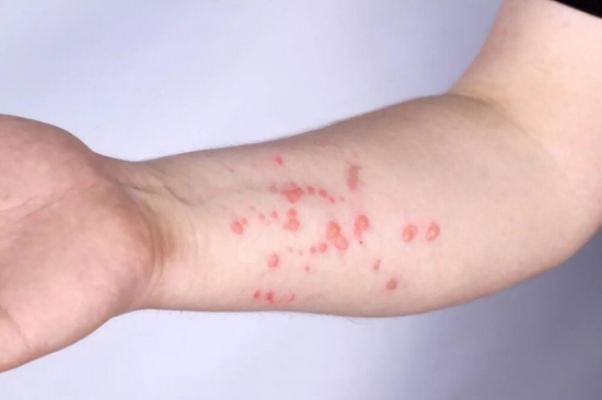 Barra do Garças tem quatro casos suspeitos de varíola dos macacos, diz SES