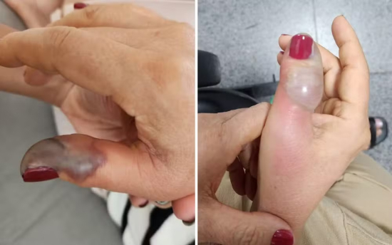Mulher perde parte do dedo após infecção contraída durante procedimento de manicure 