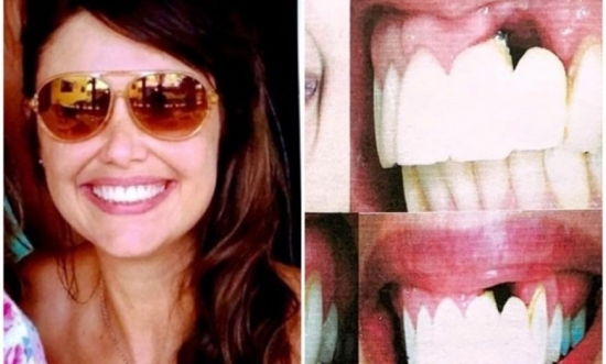 TJ mantém condenação de dentista de Barra do Garças por “buraco” em gengiva de paciente