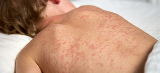 Cuiabá emite alerta para risco de sarampo e reforça importância da vacinação