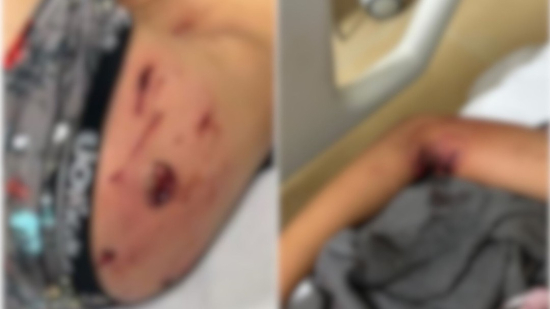 Pit bull ataca criança de 7 anos que entrou em quintal para pegar pipa