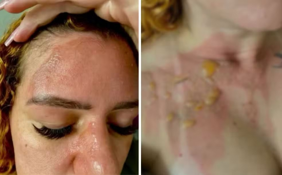 Influenciadora sofre queimaduras após explosão de panela de pressão